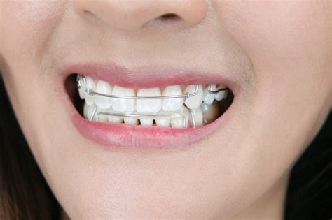 retainer with metal brackets|will wearing retainer straighten teeth.